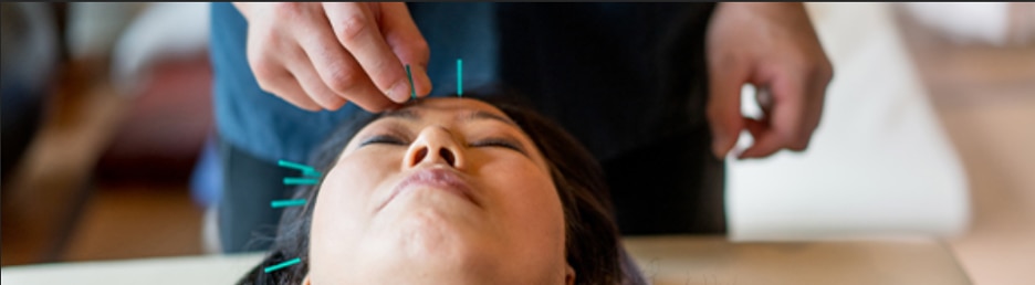 Hand placing acupuncture needles in someone’s face