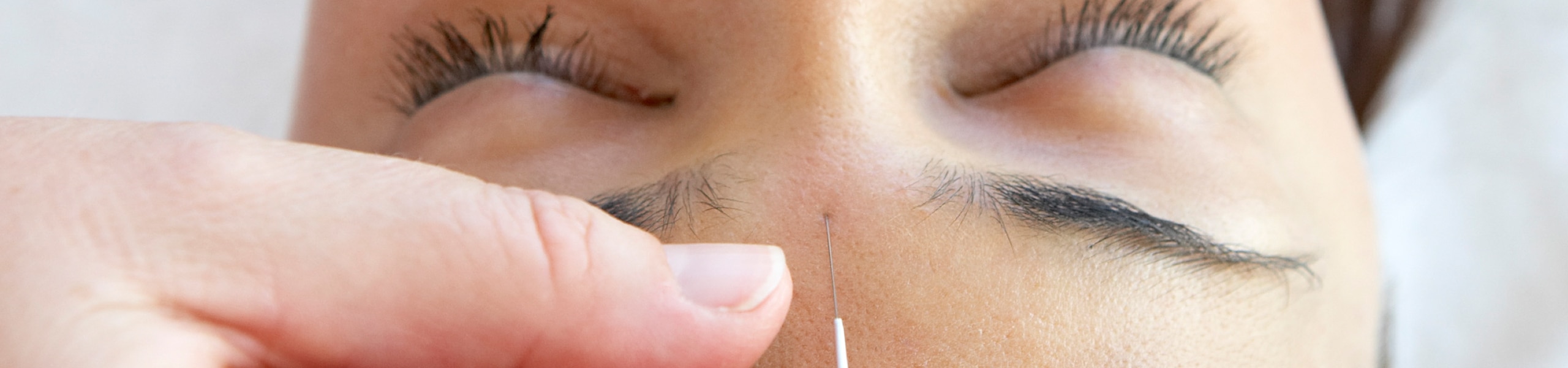 acupuncture-needle-forehead